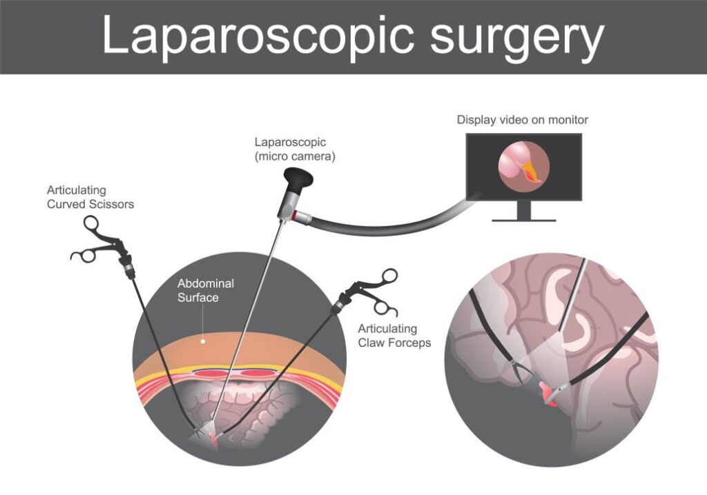 Laparoscopy Dr Mrs Manisha Munemane